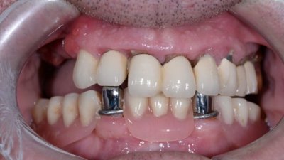 Сравнение длительного выживания имплантатов и эндодонтически леченых зубов
