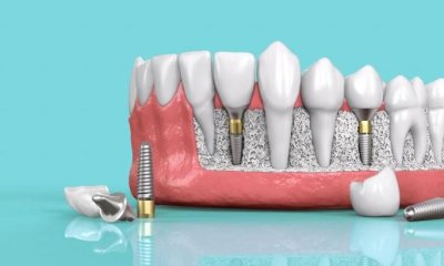 Рейтинг имплантов зубов по производителям и приживаемости