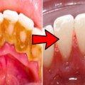 Средство от зубного камня: профессиональные и народные методы удаления